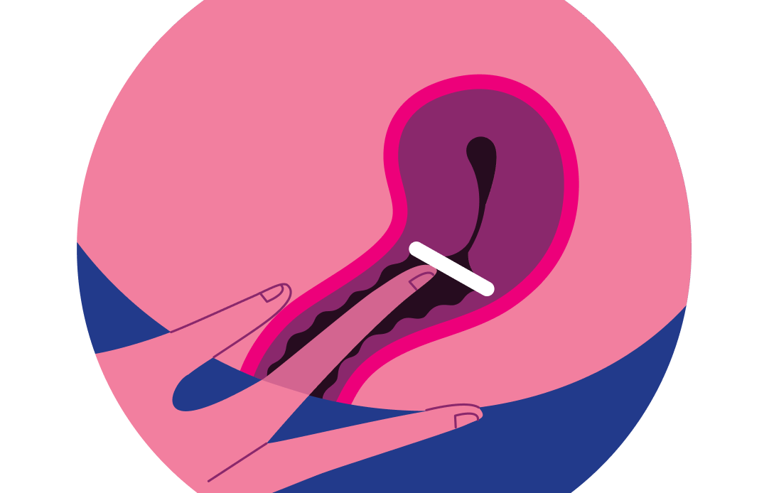 Illustrated diagram showing how to insert ANNOVERA into the vagina.